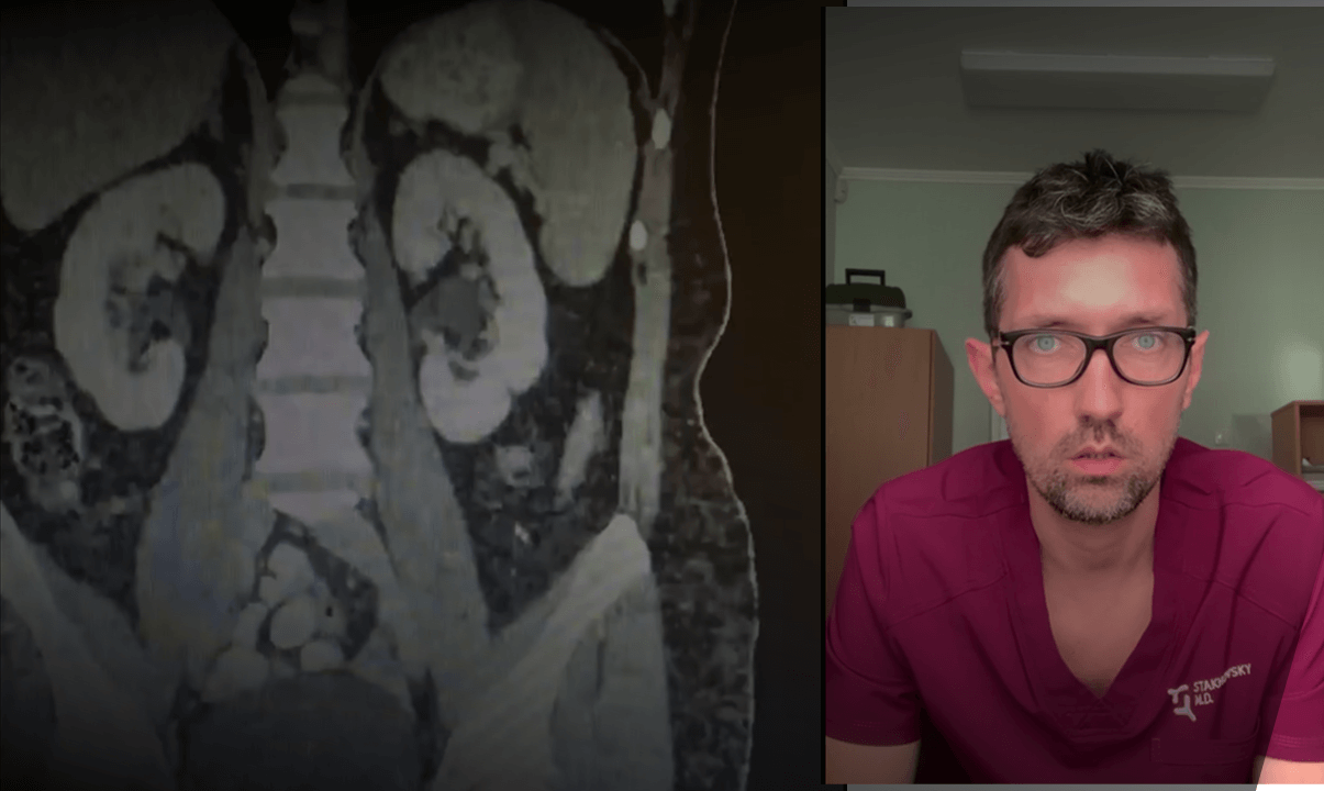 Пухлина нирки: лапароскопічна резекція (операція 2 в 1)