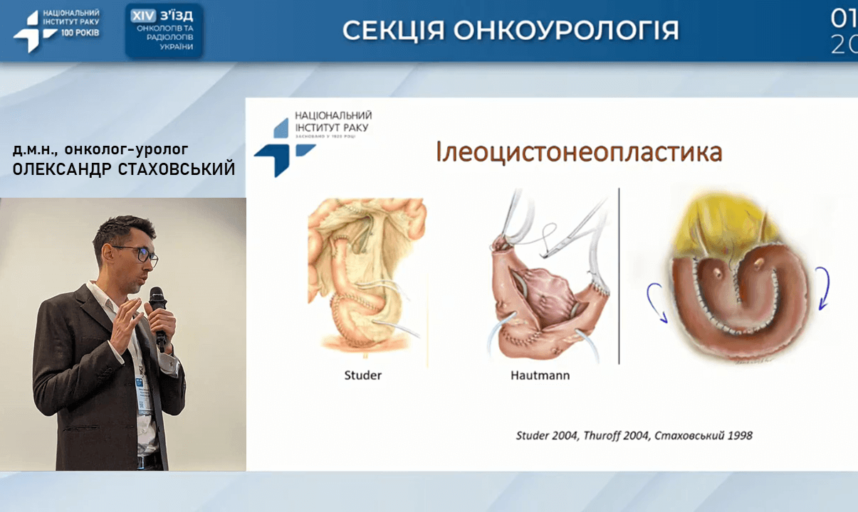Як обрати кращий метод деривації сечі після цистектомії? Розбираємо 4 найефективніші техніки